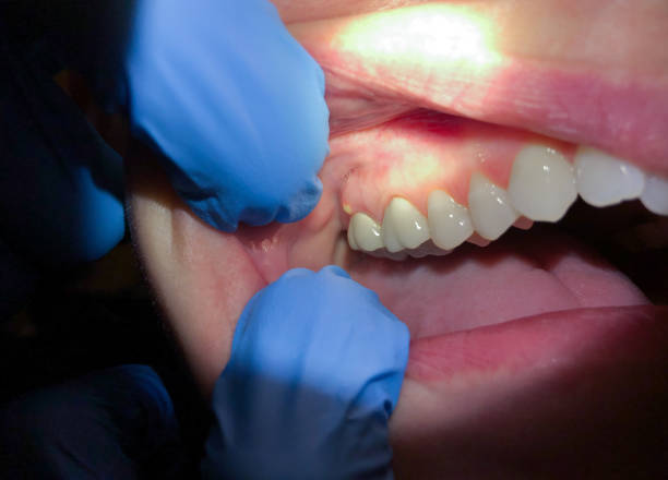 Best Broken Tooth Emergency  in Lockport, NY